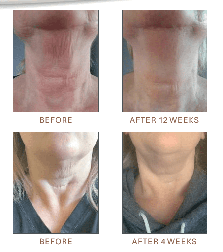 GrenzCine®  Neck - Image 2