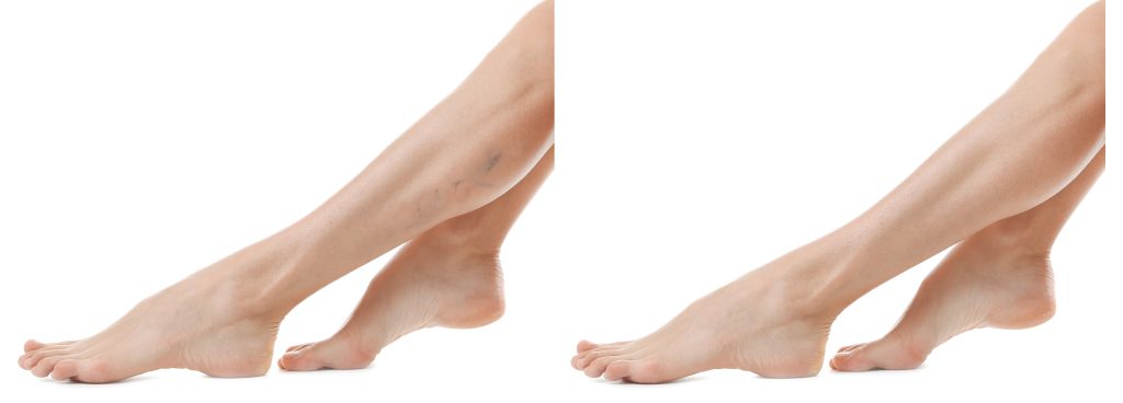 Before & after photo of veins removal procedure