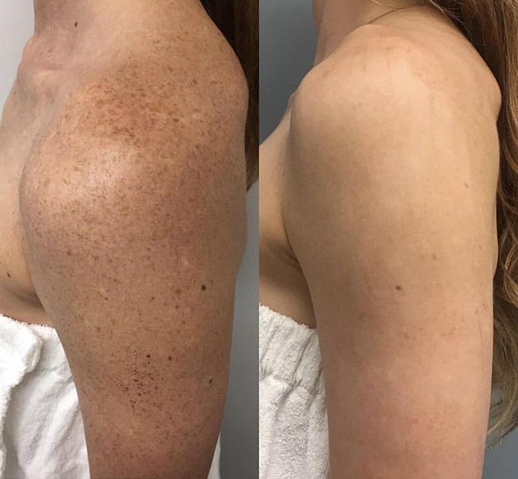 Before & after photo of pigmentation removal