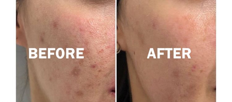 Before and after of acne treatment