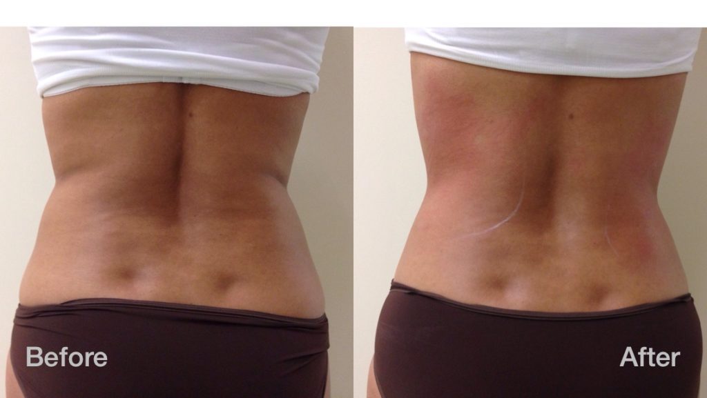 Skin Tightening & Body Contouring Treatments in Hamilton