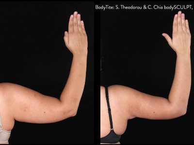 BodyTite before & after