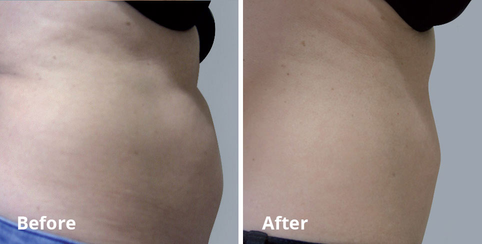 Fat & Cellulite removal before & after
