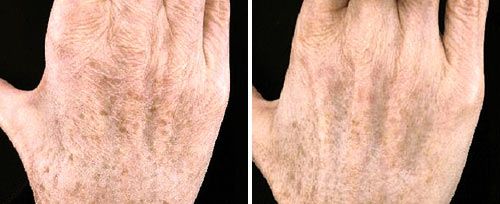 Before and after of pigmented lesion removal on hand