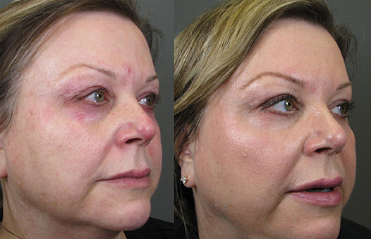 Before & after of woman useing Obagi Blue Peel®