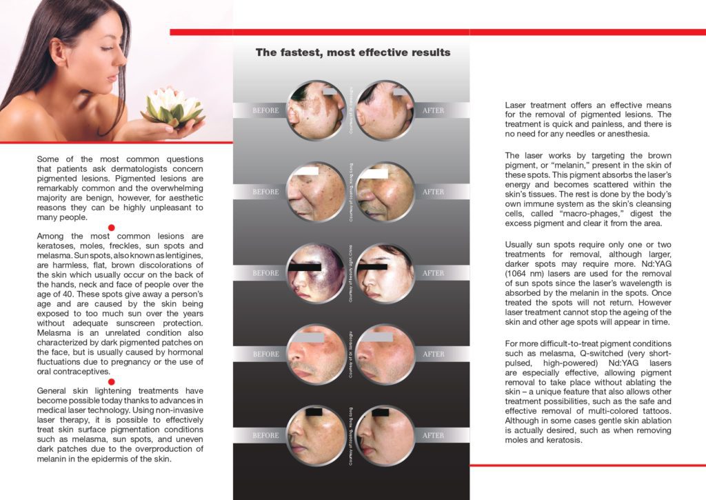 Laser treatment for pigmented lesions brochure