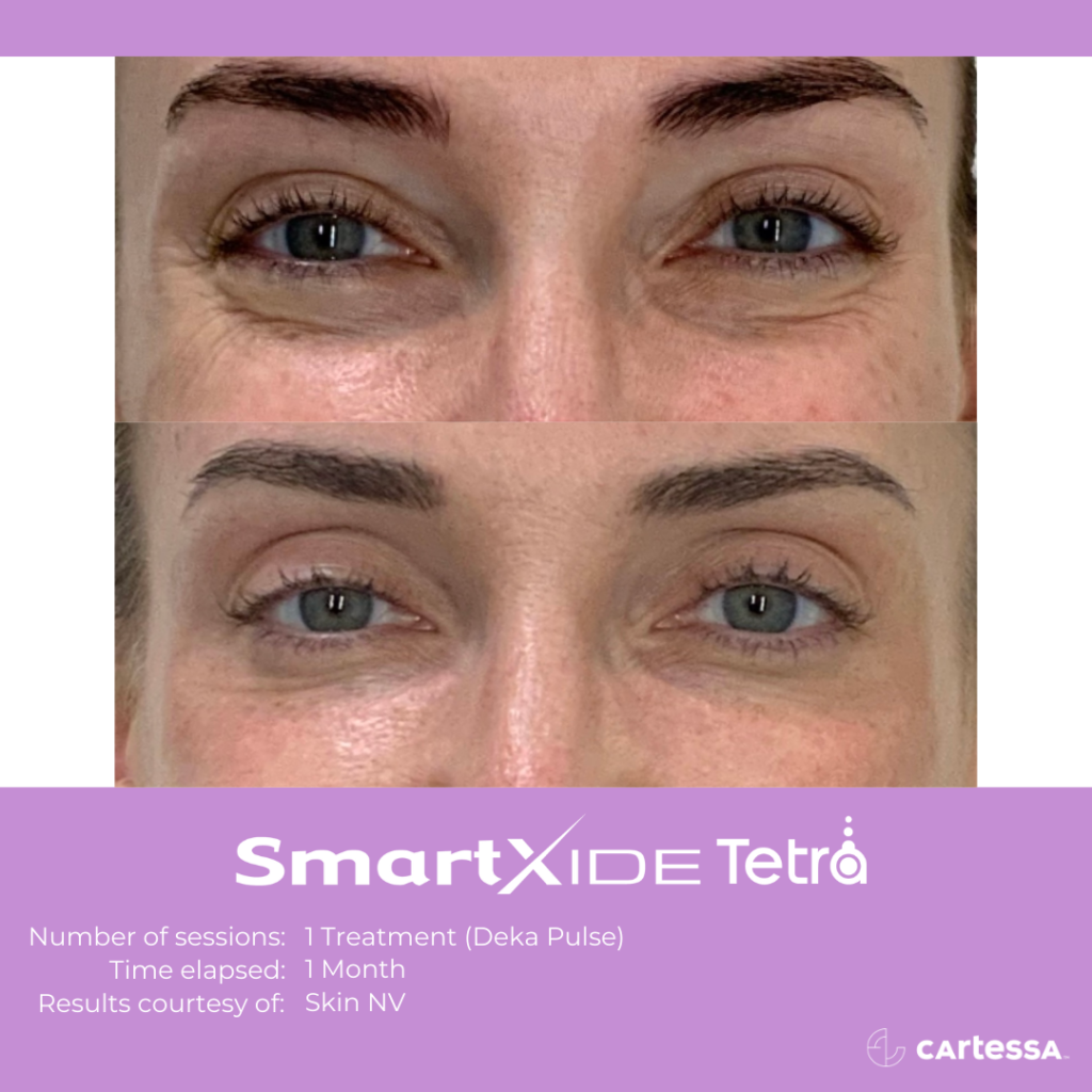 Tetra CO2 Eye treatment Before and After