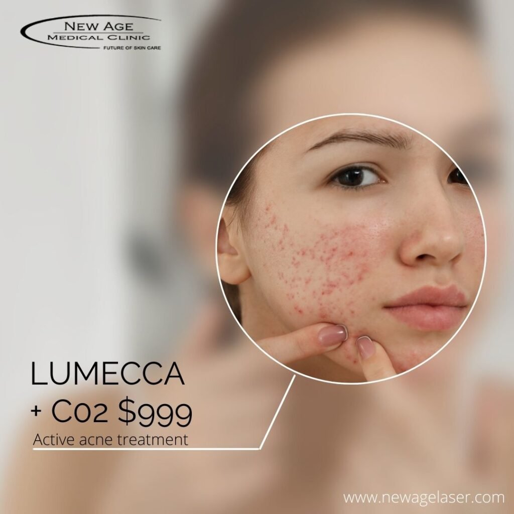 Close-up of a woman's face with acne.