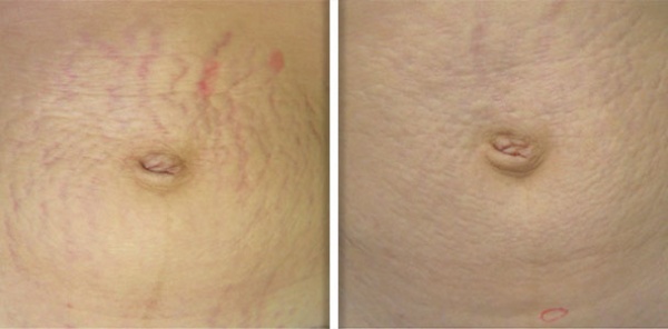 Achieving Smooth Skin: The Science Behind Fotona Laser Treatment for Stretch Mark Reduction