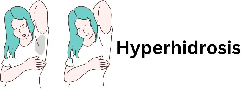 Understanding Hyperhidrosis: Causes, Symptoms, and Treatment