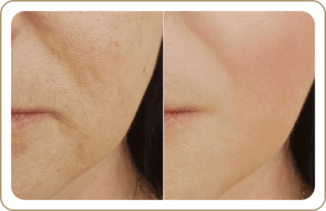 New Age Laser Clinic | Medical Spa & Laser Clinic | Laser Acne Treatment