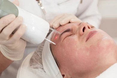 New Age Laser Clinic | Medical Spa & Laser Clinic|Laser Acne Treatment Hamilton