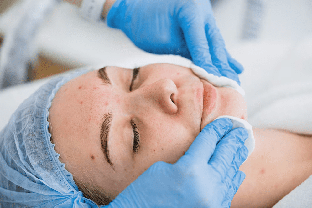 New Age Laser Clinic | Medical Spa & Laser Clinic | Achieve Acne-Free Skin Faster with Face Laser Acne Treatment 