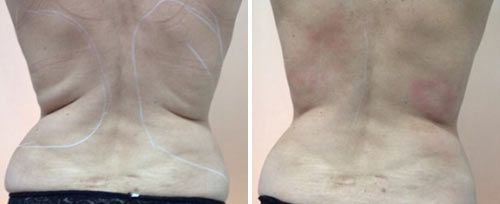 New Age Laser Clinic | Medical Spa & Laser Clinic | TightSculpting® Skin Tightening