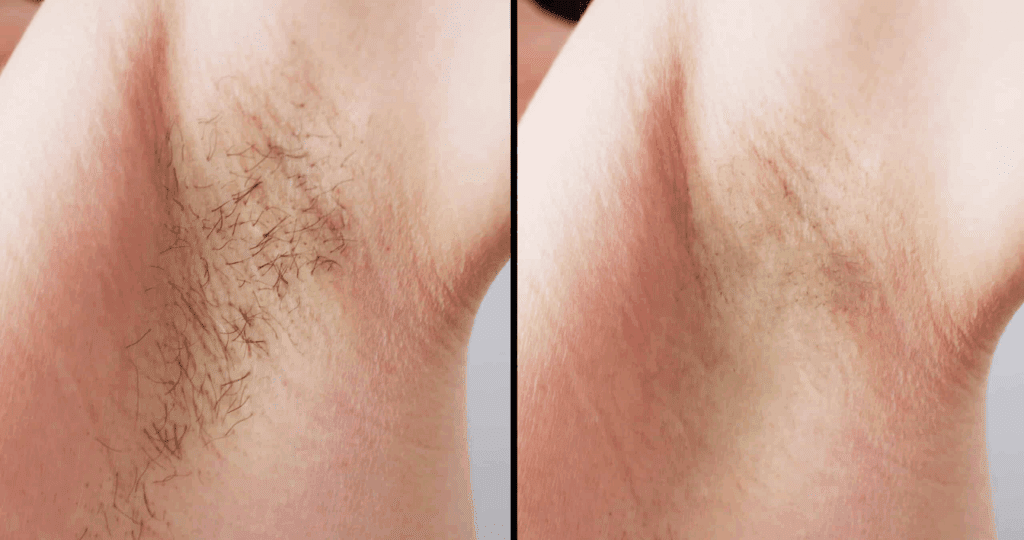 New Age Laser Clinic | Medical Spa & Laser Clinic | Soprano Ice™ by Alma™ Laser Hair Removal